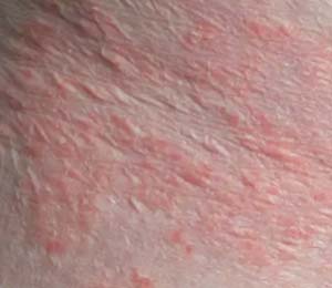 bowen-disease