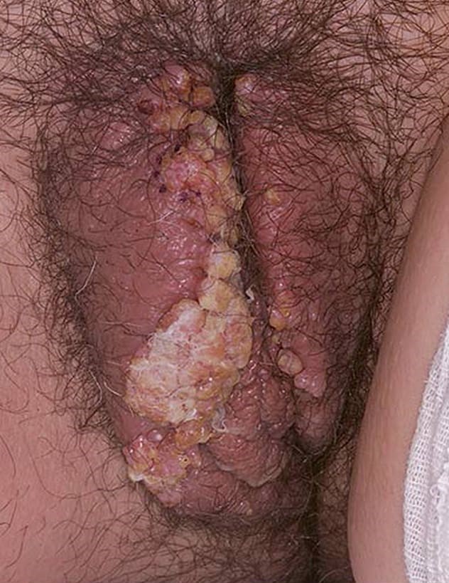 Female genital warts