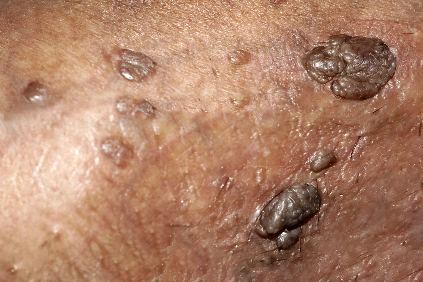 hpv_bigbead