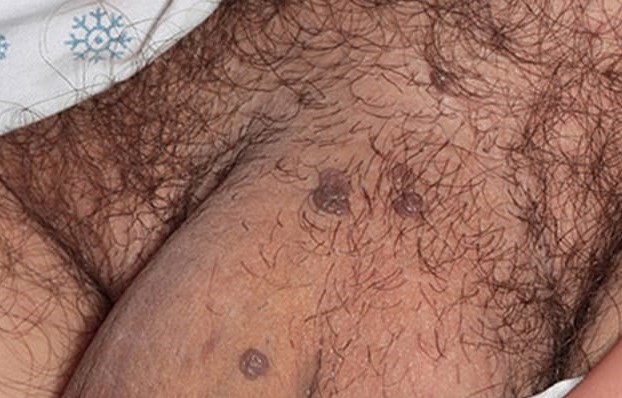 male genital warts