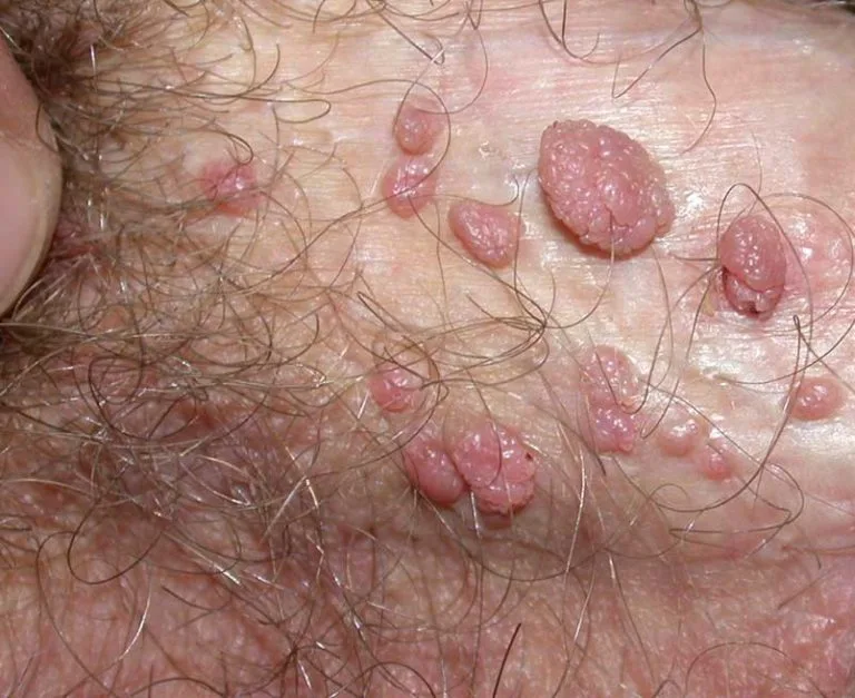warts-genital1